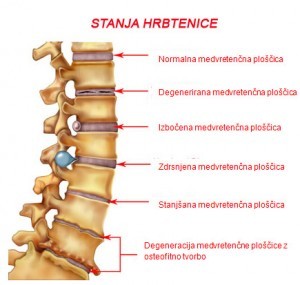 Vas zanima zakaj imate koronične bolečine v križu in kako jih odpravite?